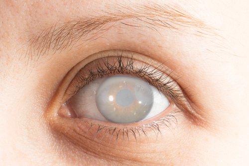 Đục thủy tinh thể hay còn gọi là đục nhân mắt, bệnh cườm khô, hay cườm đá,.. là hiện tượng của các bệnh về đục thủy tinh thể trong mắt bị mờ đục. Không còn trong suốt gây suy giảm thị lực, nhìn mờ thậm chí có thể dẫn tới mù lòa.